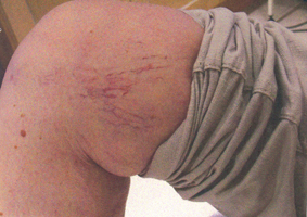 **Leg Vein Removal Treatment, Professional Essex Clinic est. since 1990** 