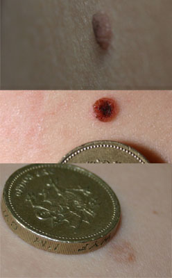 How to remove MOLES, (nevi) and WARTS easily.