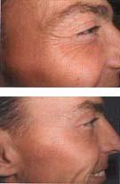 Breast Enlargement Czech Republic