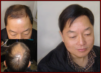 Helping you regain your hair suite- hair replacement solutions