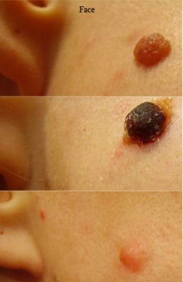 Moles, Warts, Skin Tags, Verrucas, gone in 20 minutes.